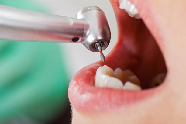 Best Emergency Tooth Extraction in Hainesvle, IL